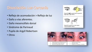 • Reflejo de acomodación > Reflejo de luz
• Daño a vías aferentes.
• Daño mesencéfalo dorsal
• Síndrome de Parinaud
• Pupila de Argyll Robertson
• Otros
 