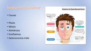 • Causas
• Ptosis
• Miosis
• Anhidrosis
• Enoftalmos
• Heterocromia iridis
 