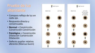 • Compara reflejo de luz en
cada ojo.
• Respuesta directa y
consensuada.
• Normal = Constricción
Constricción Constricción
• Patológico = Constricción
Dilatación Constricción
Dilatación
• Defecto pupilar relativo
aferente (Marcus Gunn)
 