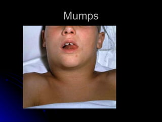 Mumps
 