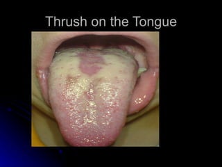Thrush on the Tongue
 