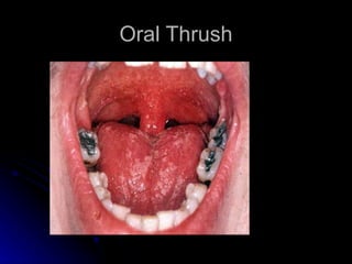 Oral Thrush
 