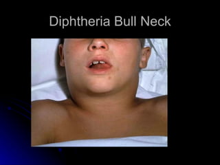 Diphtheria Bull Neck
 