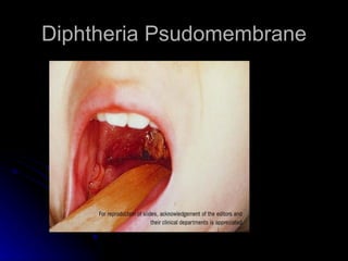 Diphtheria Psudomembrane
 