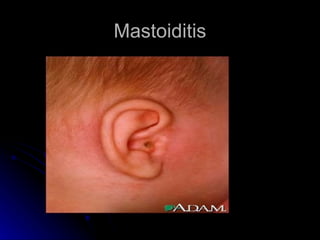 Mastoiditis
 