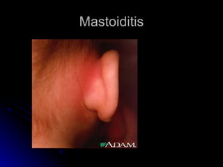 Mastoiditis
 