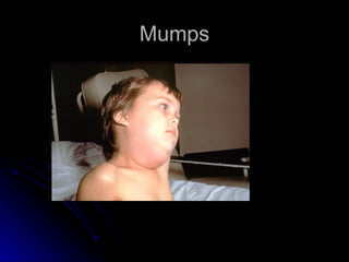 Mumps
 