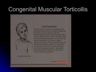 Congenital Muscular Torticollis
 