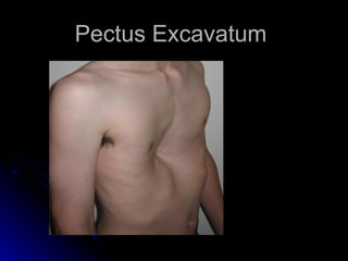 Pectus Excavatum
 