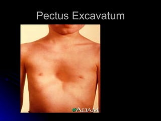 Pectus Excavatum
 
