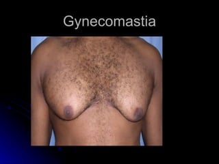 Gynecomastia
 