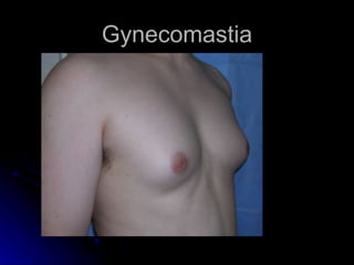 Gynecomastia
 