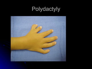 Polydactyly
 