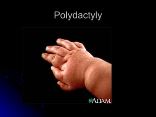 Polydactyly
 