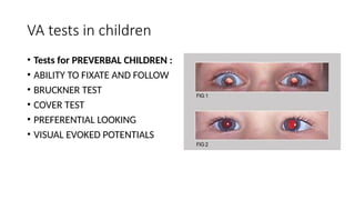Preferential Looking Test Examples Examination in strabissmus (1).pptxdsfedf | PPTX