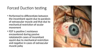 Examination in strabissmus (1).pptxdsfedf | PPTX