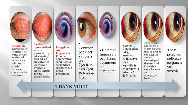 Examination of Conjunctiva.Abnormalities .pptx