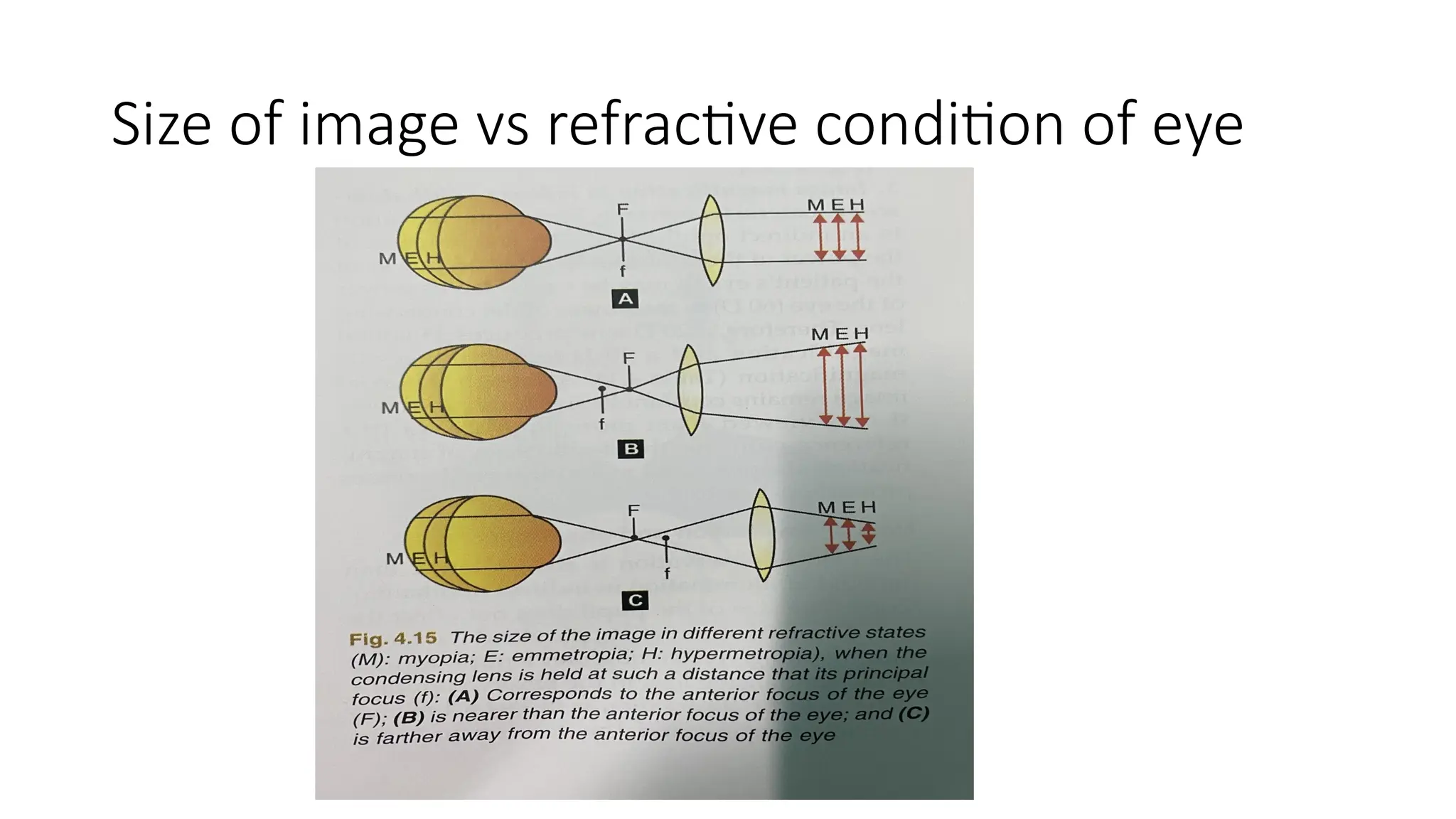 Size of image vs refractive condition of eye
 