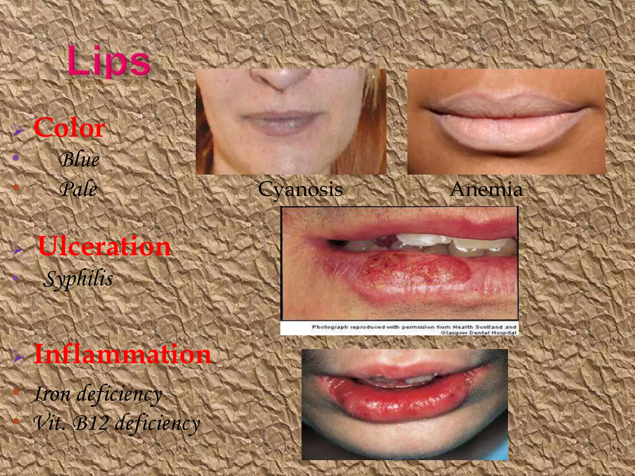  Color
• Blue
• Pale Cyanosis Anemia
 Ulceration
• Syphilis
 Inflammation
• Iron deficiency
• Vit. B12 deficiency
 