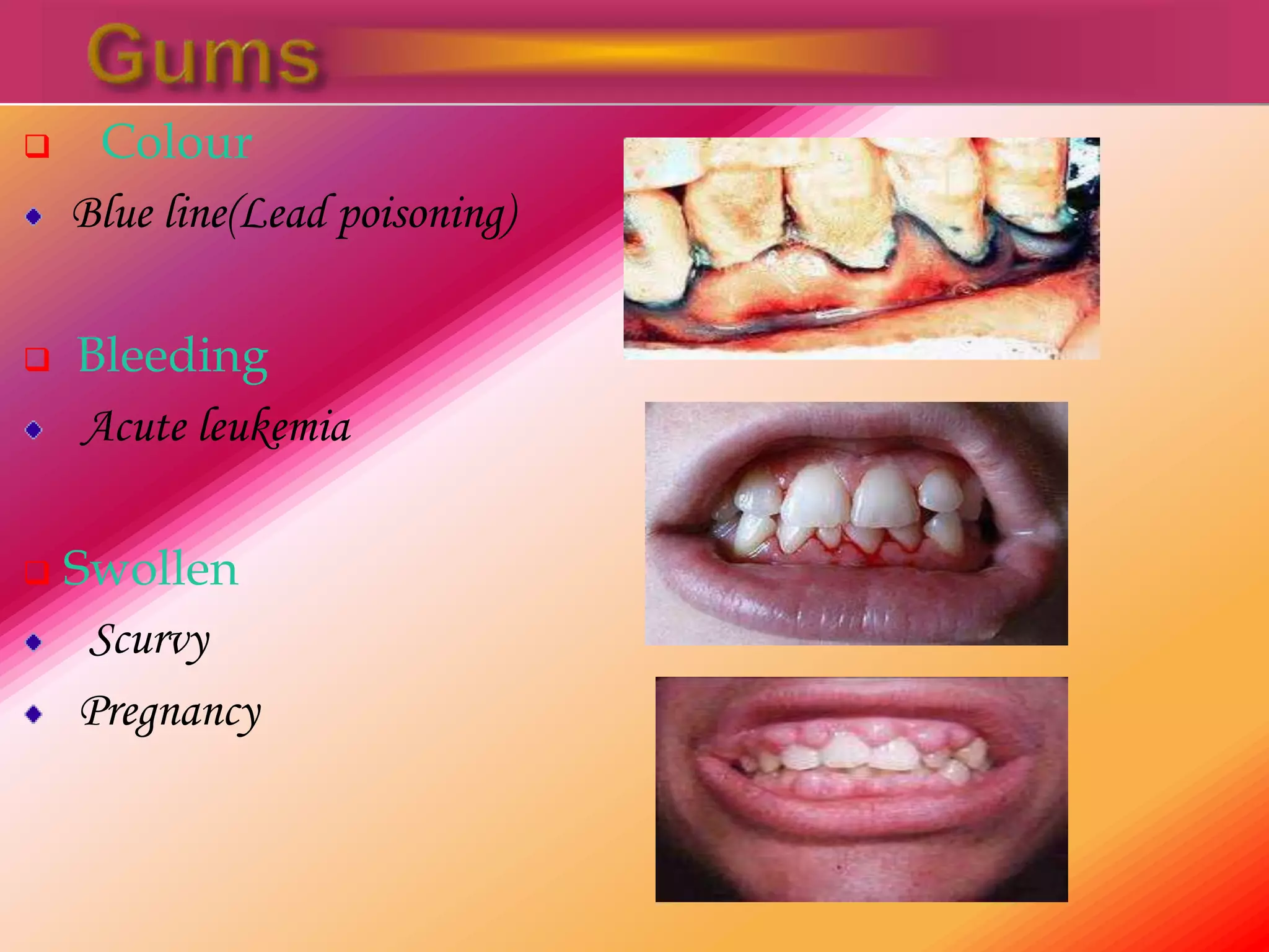  Colour
Blue line(Lead poisoning)
 Bleeding
Acute leukemia
 Swollen
Scurvy
Pregnancy
 