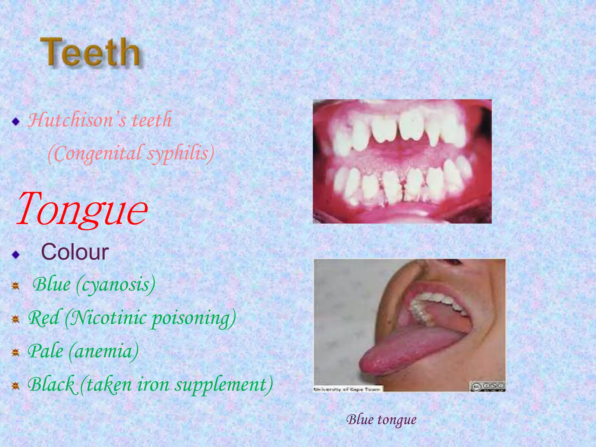 Hutchison’s teeth
(Congenital syphilis)
Tongue
Colour
Blue (cyanosis)
Red (Nicotinic poisoning)
Pale (anemia)
Black (taken iron supplement)
Blue tongue
 