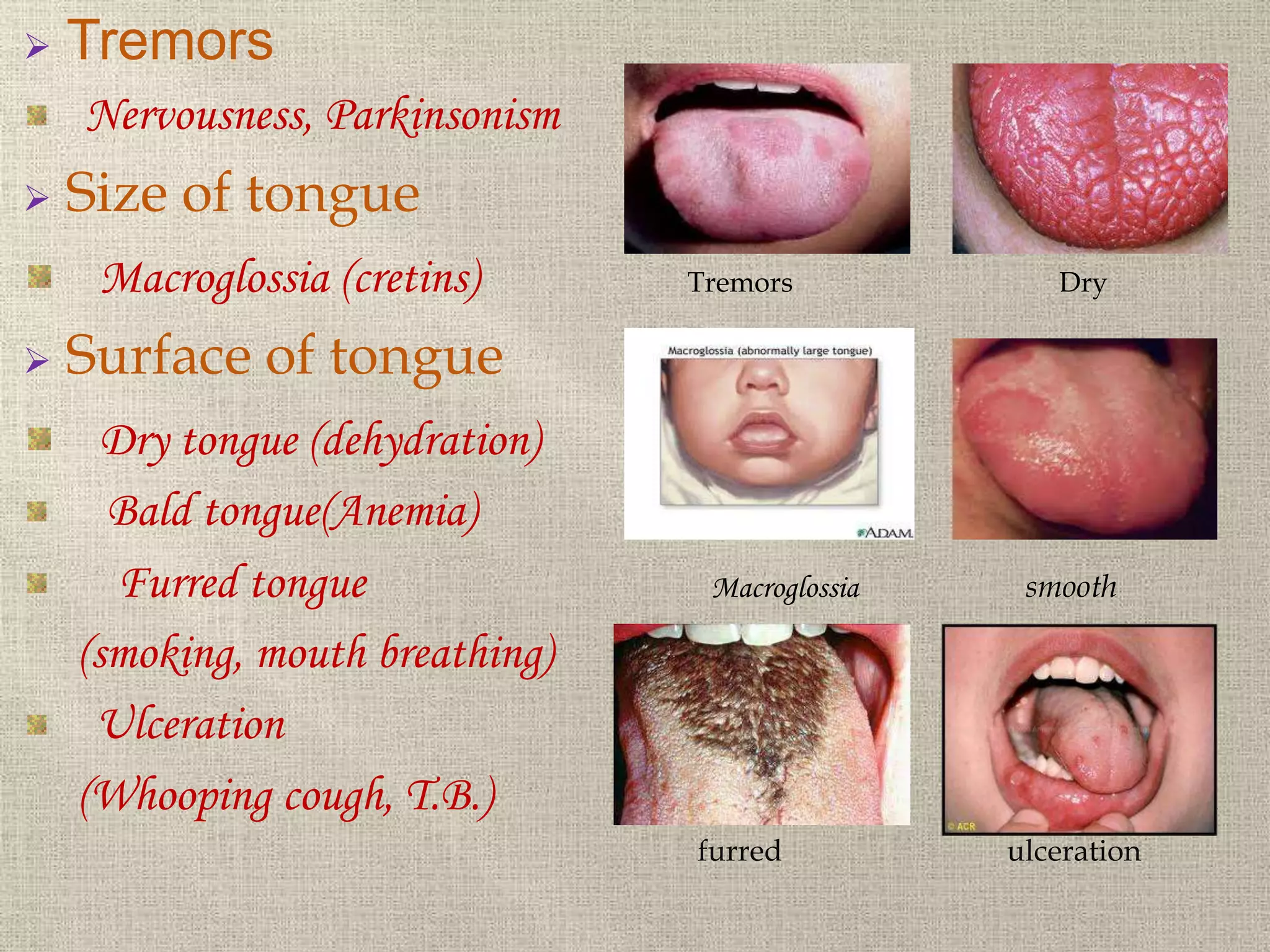  Tremors
Nervousness, Parkinsonism
 Size of tongue
Macroglossia (cretins) Tremors Dry
 Surface of tongue
Dry tongue (dehydration)
Bald tongue(Anemia)
Furred tongue Macroglossia smooth
(smoking, mouth breathing)
Ulceration
(Whooping cough, T.B.) Macroglossia
furred ulceration
 