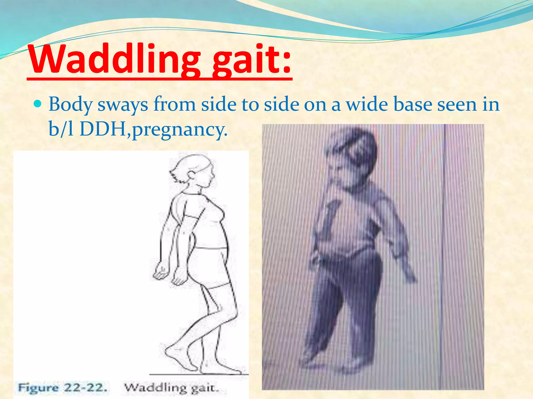 Waddling gait:
 Body sways from side to side on a wide base seen in
b/l DDH,pregnancy.
 