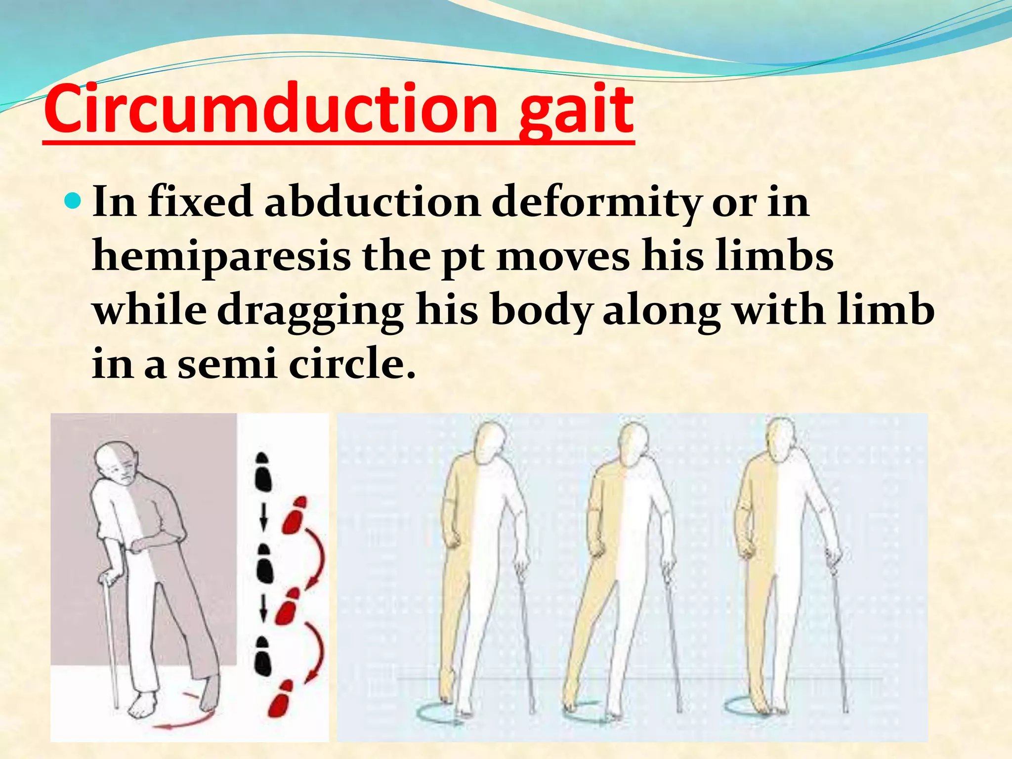 Circumduction gait
 In fixed abduction deformity or in
hemiparesis the pt moves his limbs
while dragging his body along with limb
in a semi circle.
 