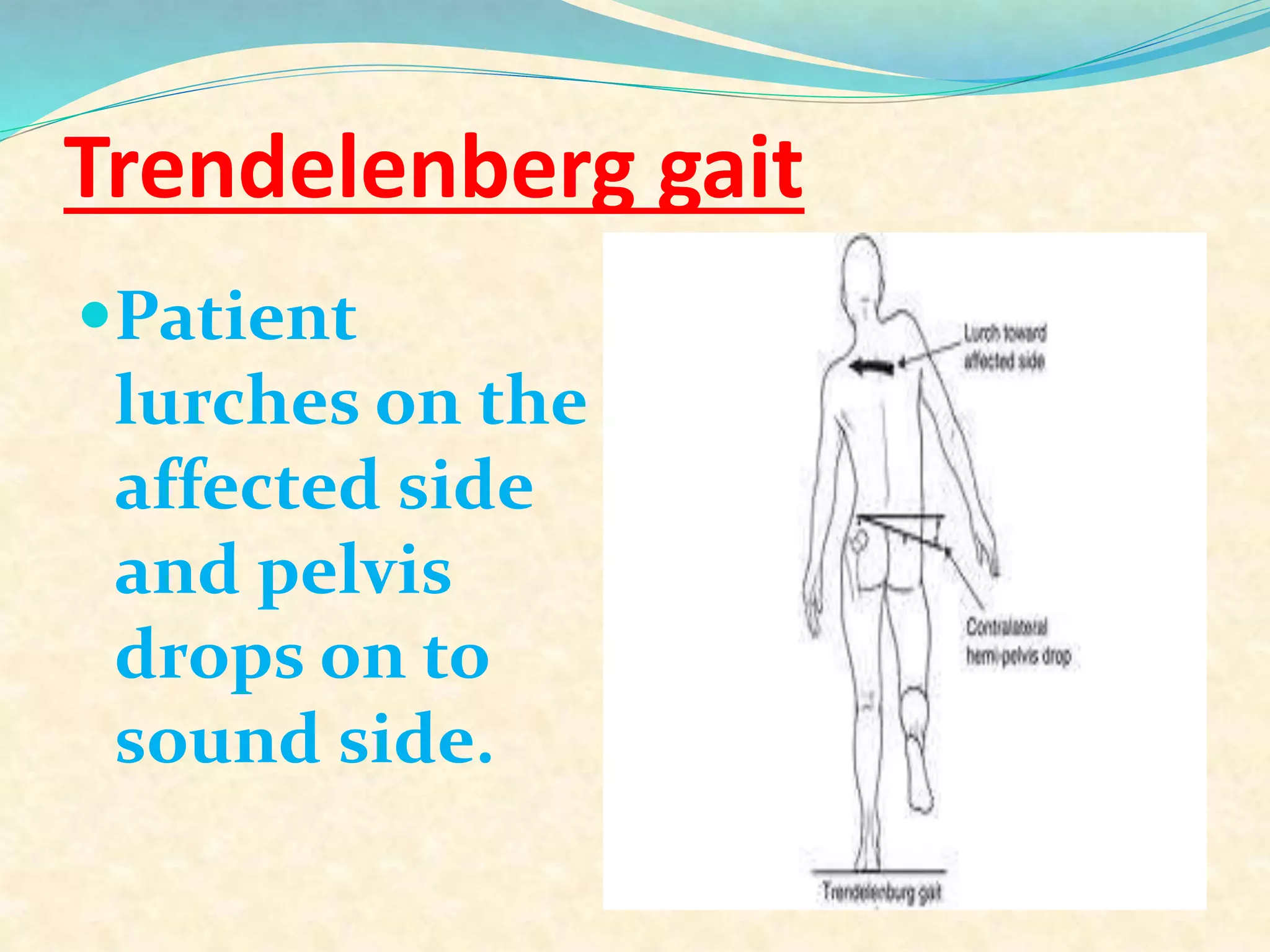 Trendelenberg gait
Patient
lurches on the
affected side
and pelvis
drops on to
sound side.
 