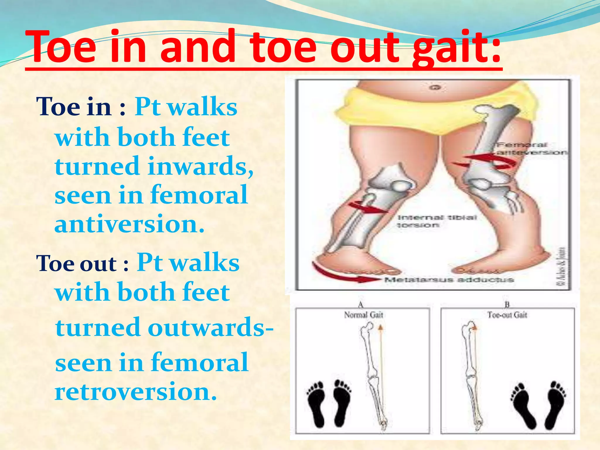 Toe in and toe out gait:
Toe in : Pt walks
with both feet
turned inwards,
seen in femoral
antiversion.
Toe out : Pt walks
with both feet
turned outwards-
seen in femoral
retroversion.
 