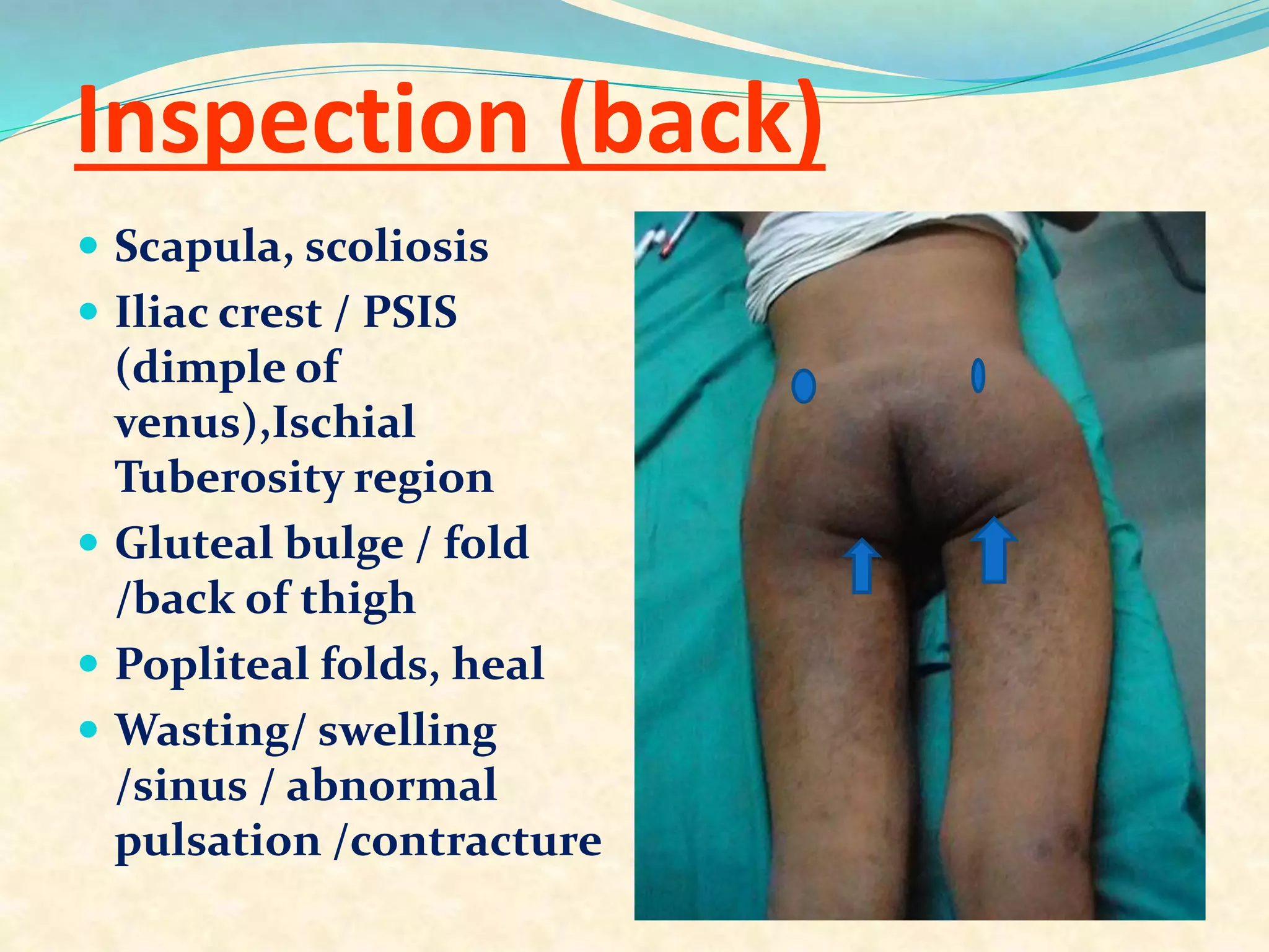 Inspection (back)
 Scapula, scoliosis
 Iliac crest / PSIS
(dimple of
venus),Ischial
Tuberosity region
 Gluteal bulge / fold
/back of thigh
 Popliteal folds, heal
 Wasting/ swelling
/sinus / abnormal
pulsation /contracture
 