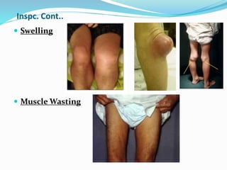 Inspc. Cont..
 Swelling
 Muscle Wasting
 