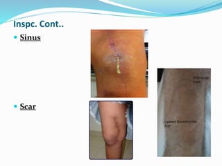 Inspc. Cont..
 Sinus
 Scar
 