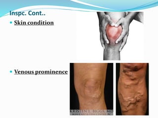 Inspc. Cont..
 Skin condition
 Venous prominence
 