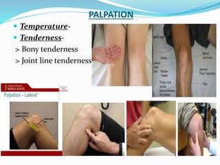 PALPATION
 Temperature-
 Tenderness-
> Bony tenderness
> Joint line tenderness
 