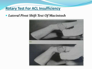 Rotary Test For ACL Insufficiency
 Lateral Pivot Shift Test Of Macintosh
 