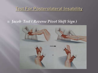  Jacob Test ( Reverse Pivot Shift Sign )
 