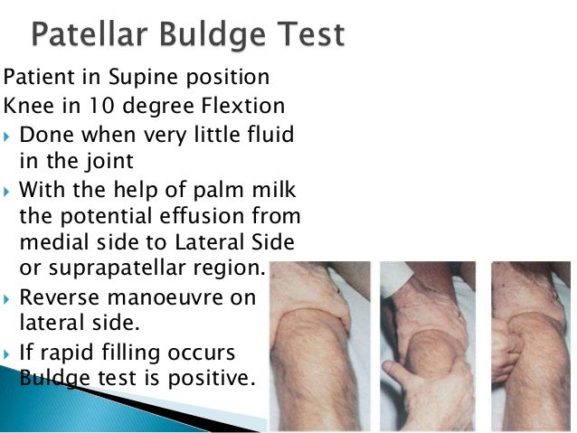 knee effusion treatment knee effusion treatment