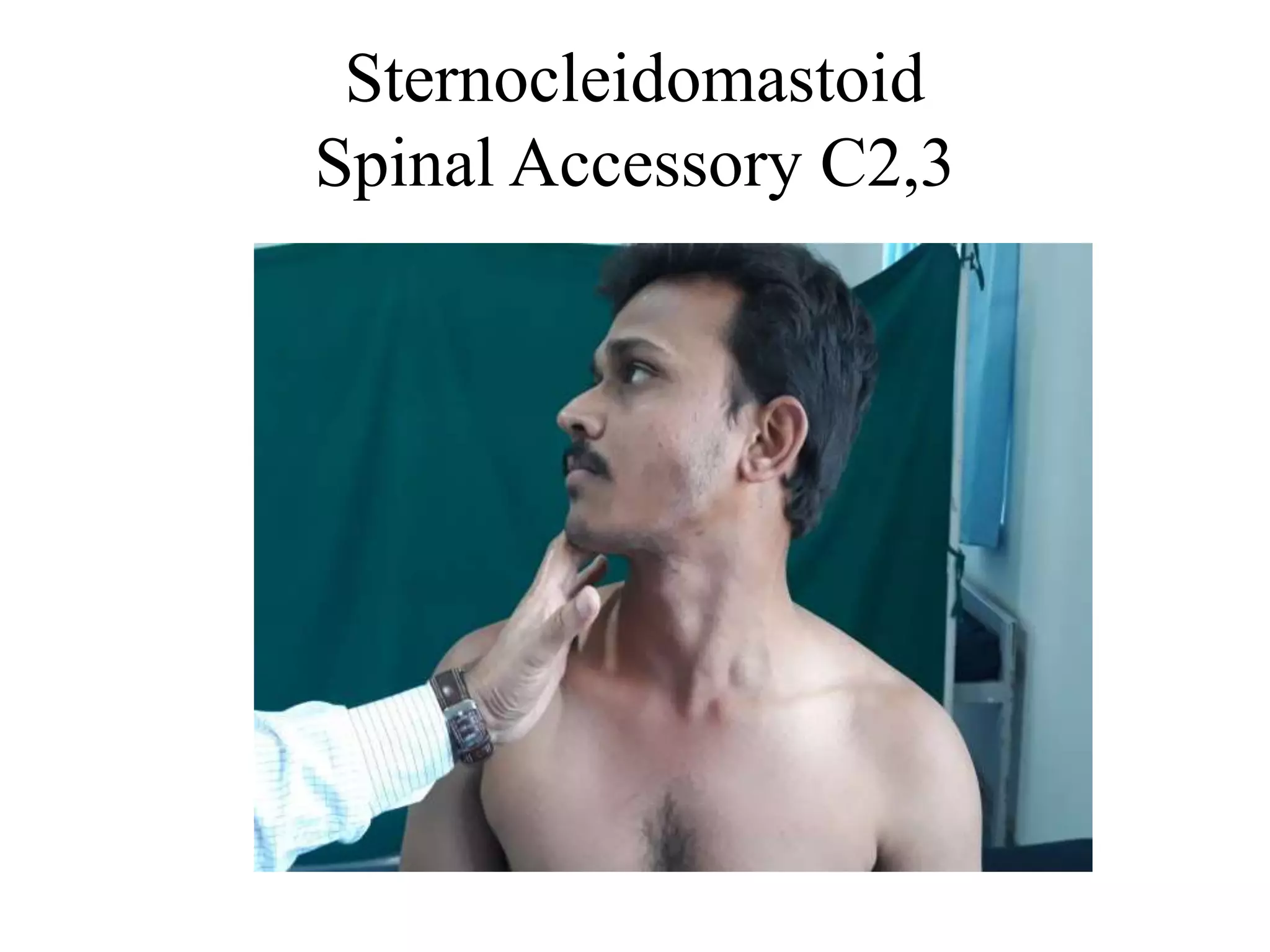 Sternocleidomastoid
Spinal Accessory C2,3
 