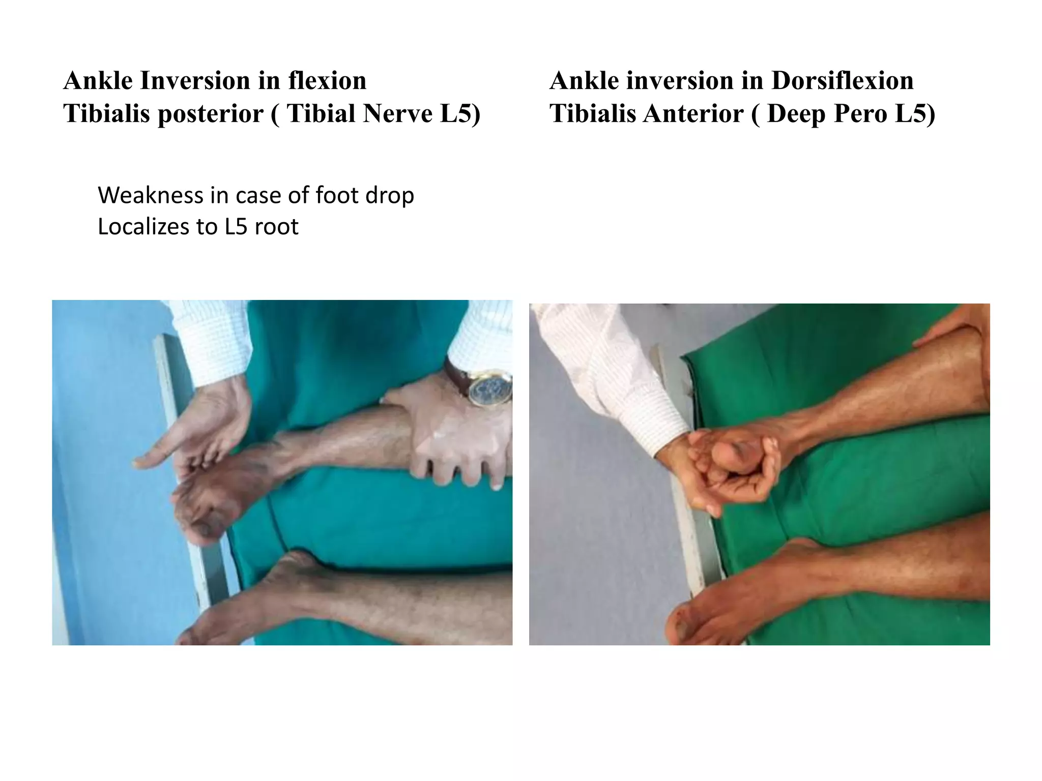 Ankle Inversion in flexion
Tibialis posterior ( Tibial Nerve L5)
Ankle inversion in Dorsiflexion
Tibialis Anterior ( Deep Pero L5)
Weakness in case of foot drop
Localizes to L5 root
 