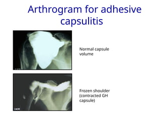 Hip Arthrogram Volume EXAMINATION OF SHOULDER JOINT-1.pptxdhjdj | PPTX