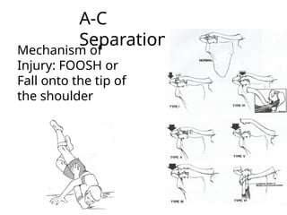 Fall Onto R Shoulder EXAMINATION OF SHOULDER JOINT-1.pddfffptx | PPTX