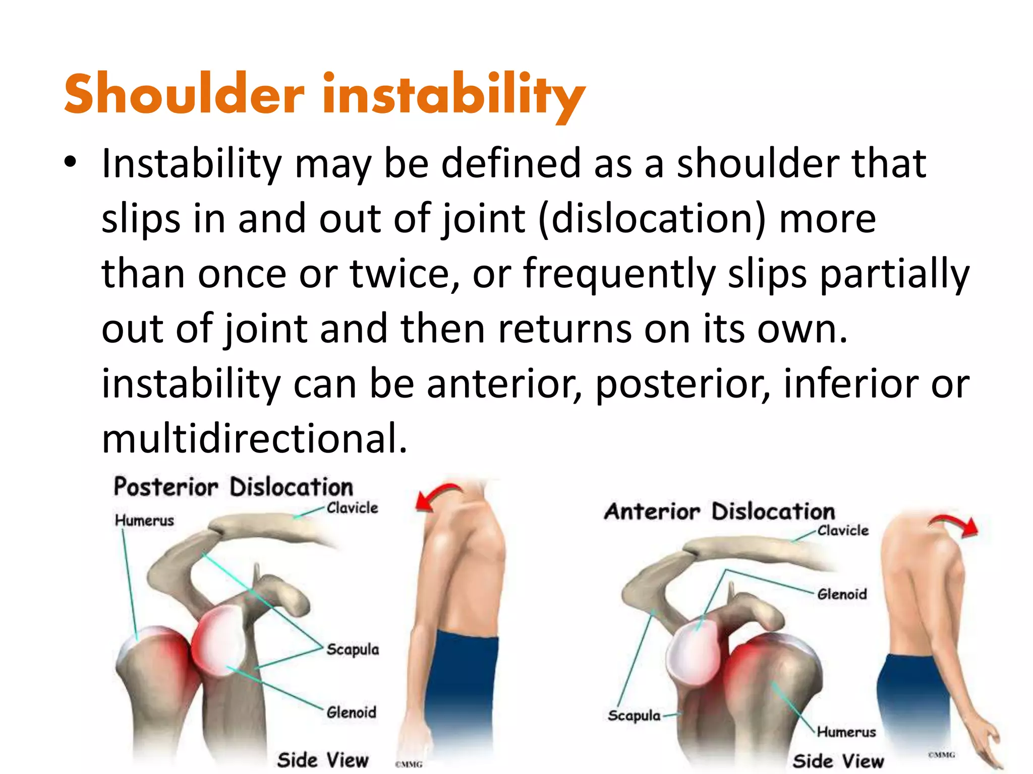 Shoulder instability
• Instability may be defined as a shoulder that
slips in and out of joint (dislocation) more
than once or twice, or frequently slips partially
out of joint and then returns on its own.
instability can be anterior, posterior, inferior or
multidirectional.
 