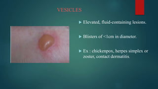 Vesication EXAMINATION OF SKIN.pptx