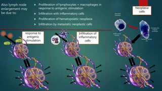 Infiltration of
inflammatory
cells
response to
antigenic
stimulation
Also lymph node
enlargement may
be due to:
 Proliferation of lymphocytes + macrophages in
response to antigenic stimulation
 Infiltration with inflammatory cells
 Proliferation of hematopoietic neoplasia
 Infiltration by metastatic neoplastic cells
Neoplasia
cells
Abundant
cytoplasm
Small, raund
nucleus
Clumped and
irregular
chromatin
Increased nuclear
size
 
