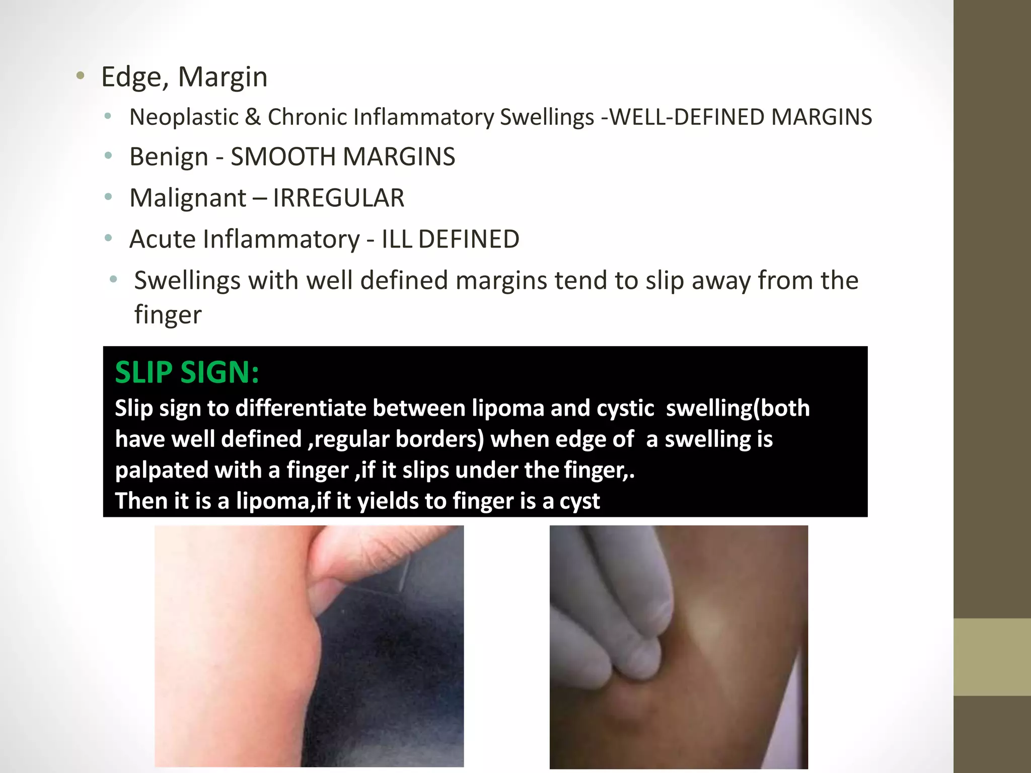 Slipped Sign Examination of swelling | PPTX