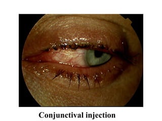 EXAMINATION OF THE ANTERIOR SEGMENT.pptx