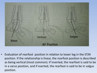 Varus Rear Foot Post Examination of the child with cerebral palsy | PPTX