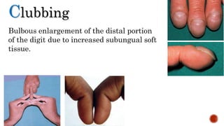 Bulbous enlargement of the distal portion
of the digit due to increased subungual soft
tissue.
Clubbing
 