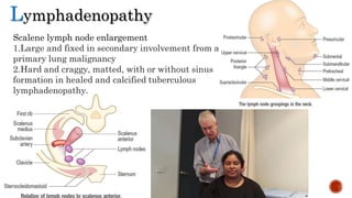 Lymphadenopathy
Scalene lymph node enlargement
1.Large and fixed in secondary involvement from a
primary lung malignancy
2.Hard and craggy, matted, with or without sinus
formation in healed and calcified tuberculous
lymphadenopathy.
 